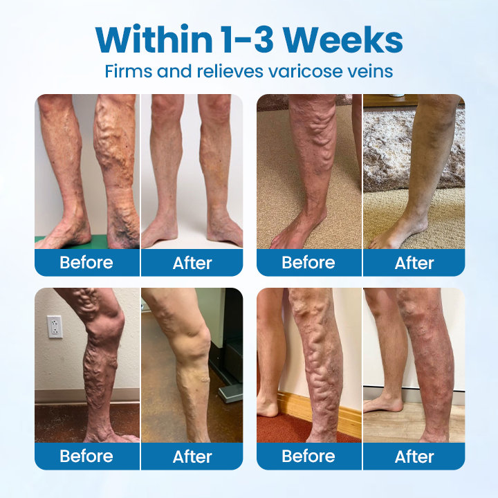 Ourlyard® VeinGuard Herbal Spray-✅ Clinically proven to eliminate varicose veins in just 7 days!