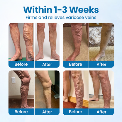 Ourlyard® VeinGuard Herbal Spray-✅ Clinically proven to eliminate varicose veins in just 7 days!